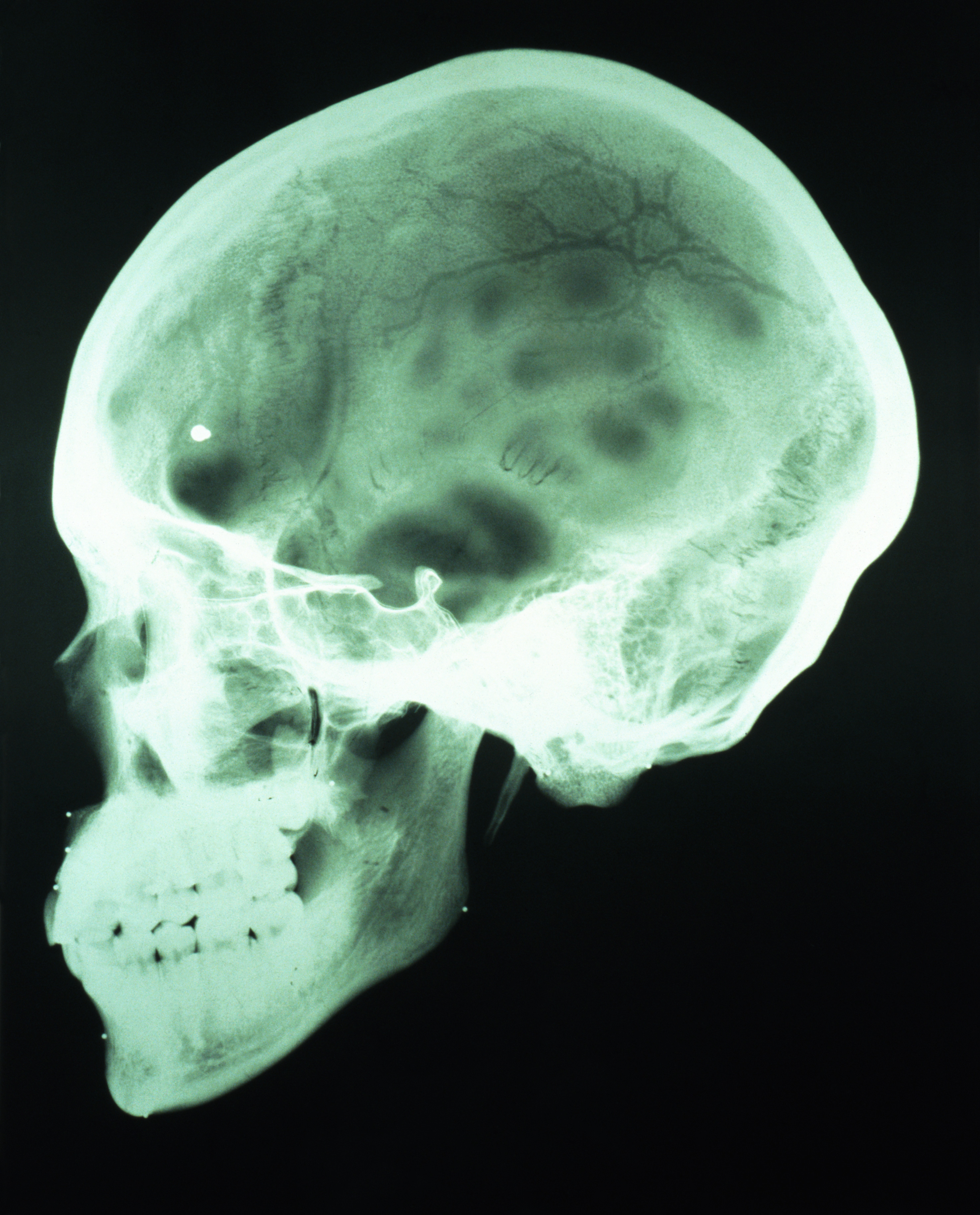 Сотрясение кости. ЧМТ повреждения костей черепа. Рентген черепа сотрясение мозга. Кости свода черепа рентген. Рентген головного мозга при сотрясении.
