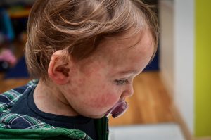 Toddler with Measles Symptoms